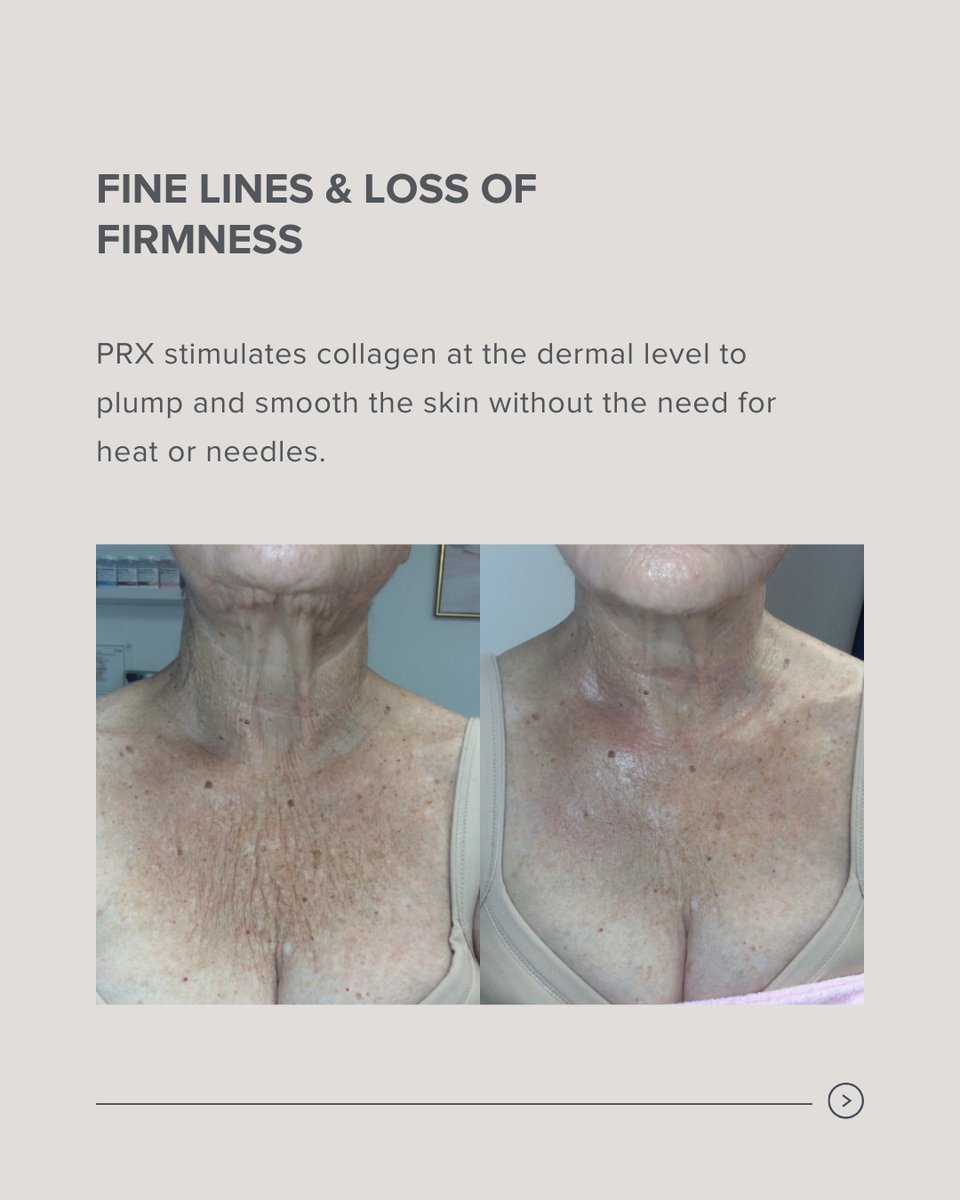 Looking for a gentle way to wake up tired, uneven skin? Our PRX peel is all glow, no downtime—just smoother, firmer, more radiant days ahead. ✨ #prxpeel