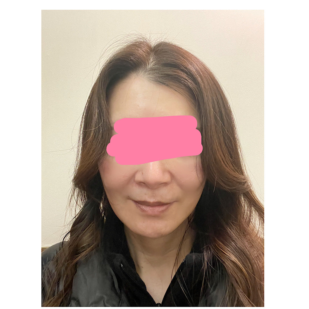 kiko 切開リフトDT中 tweet media