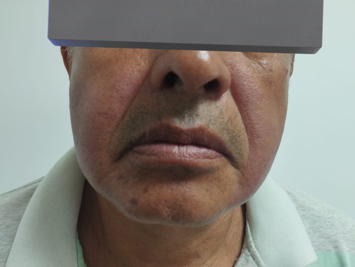 moy_qmac's tweet photo. Otro lupus que no es lupus????

Hombre de 65 años, campesino que empezo hace 1 año con dolor articular matutino, ojo seco y boca seca suuuper intensos asi como esta chulada en cara. https://t.co/lKTEnymsUc
