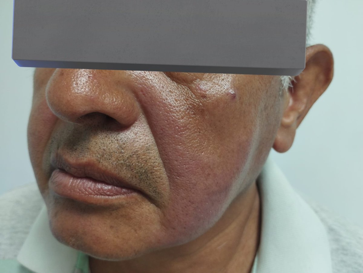 Otro lupus que no es lupus????

Hombre de 65 años, campesino que empezo hace 1 año con dolor articular matutino, ojo seco y boca seca suuuper intensos asi como esta chulada en cara.