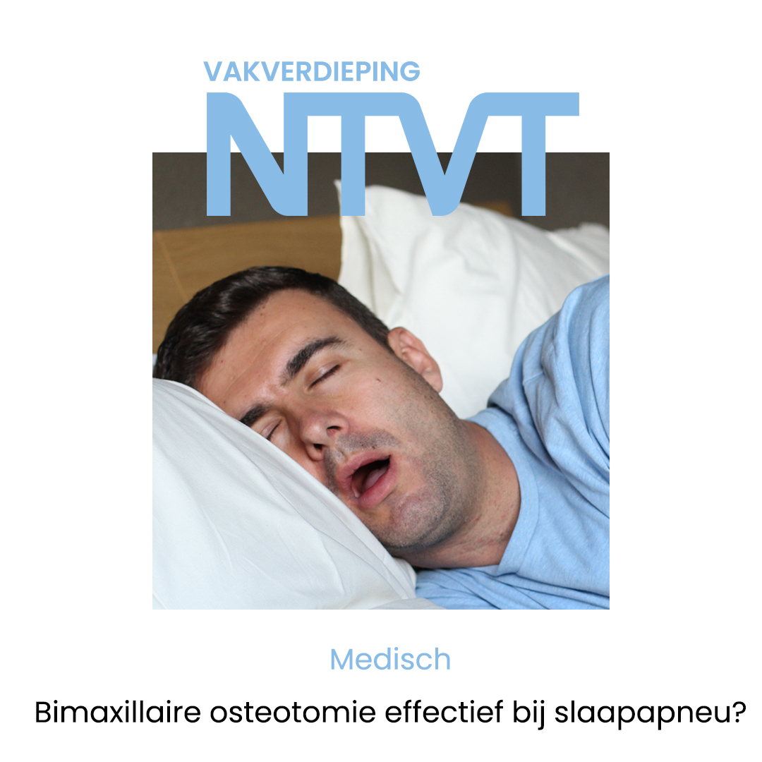NTVTredactie's tweet image. Bimaxillaire osteotomie wordt ingezet bij obstructieve slaapapneu. Onderzoek toont duurzame verbetering van respiratie en kwaliteit van leven, ondanks mogelijke bijwerkingen. 

Lees meer: doi.org/10.5177/ntvt.2… 

#OSAS #kaakchirurgie #slaapapneu #mondzorg