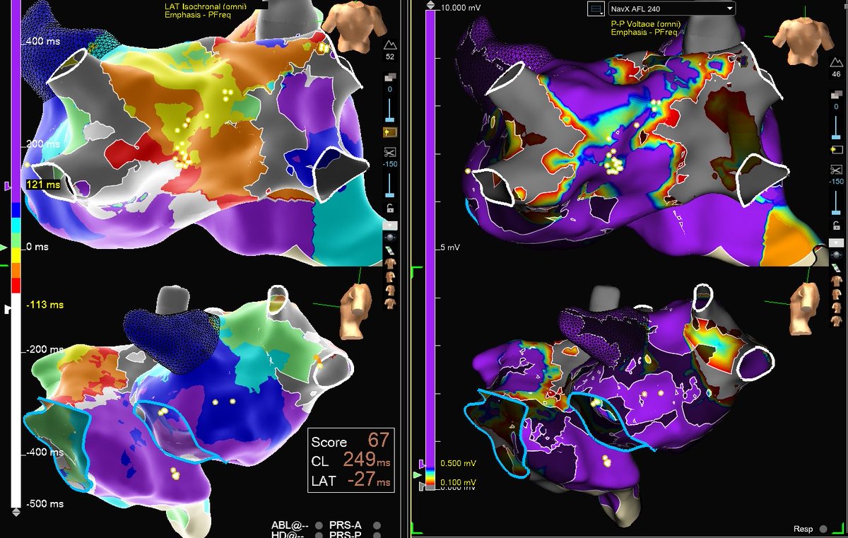 carunnarayanan's tweet photo. Roof dependent left sided atypical atrial flutter in a de-novo left atrium. Single shot termination with HD grid mapping and Farawave PFA ablation. @utmbcardiology @deansabayon @docHJ https://t.co/hiOquZBScc