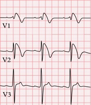 Identify the ECG sign shown.
What arrhythmia is this patient at risk of?
