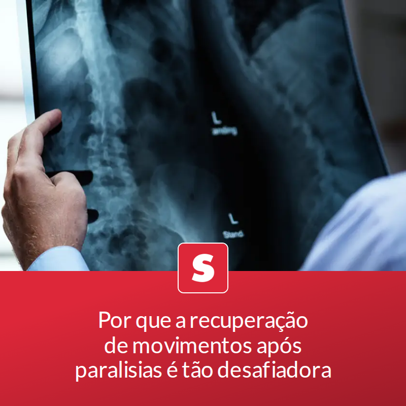 Por que a recuperação de movimentos após paralisias é tão desafiadora
Avanços em reabilitação e tecnologias assistivas ampliam a autonomia de pacientes com lesões neurológicas, mas a ciência segue em busca de soluções.
📖 Leia a matéria no... mrf.lu/zSC4