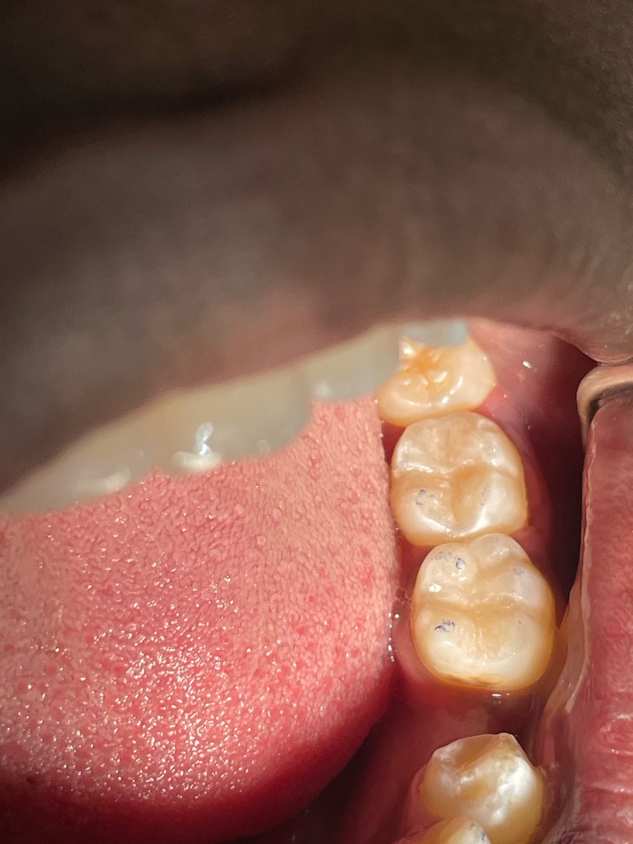 الشهر عليكم مبارك وكل عام وأنتم بخير 🌙 
Class l Composite restoration for 36,37,46 also PRR for 45