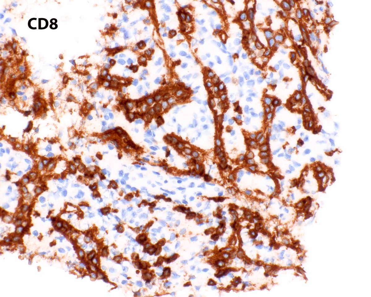 LizMontgomeryMD's tweet photo. Heterotopic spleen presenting as a very round pancreas mass.  Even I can see the lesion (well-the gastroenterologist circled it). https://t.co/o9qCY2n6qf