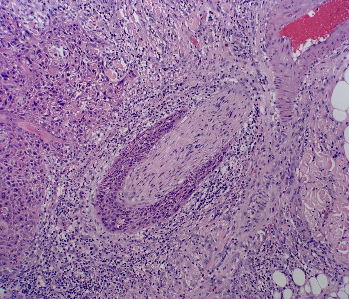 MBBS_Pathology's tweet image. Hungry tumour gobbling a nerve! Burp! #PacMan stylie
#SCC
#PerineuralInvasion
#pathology 
💚
