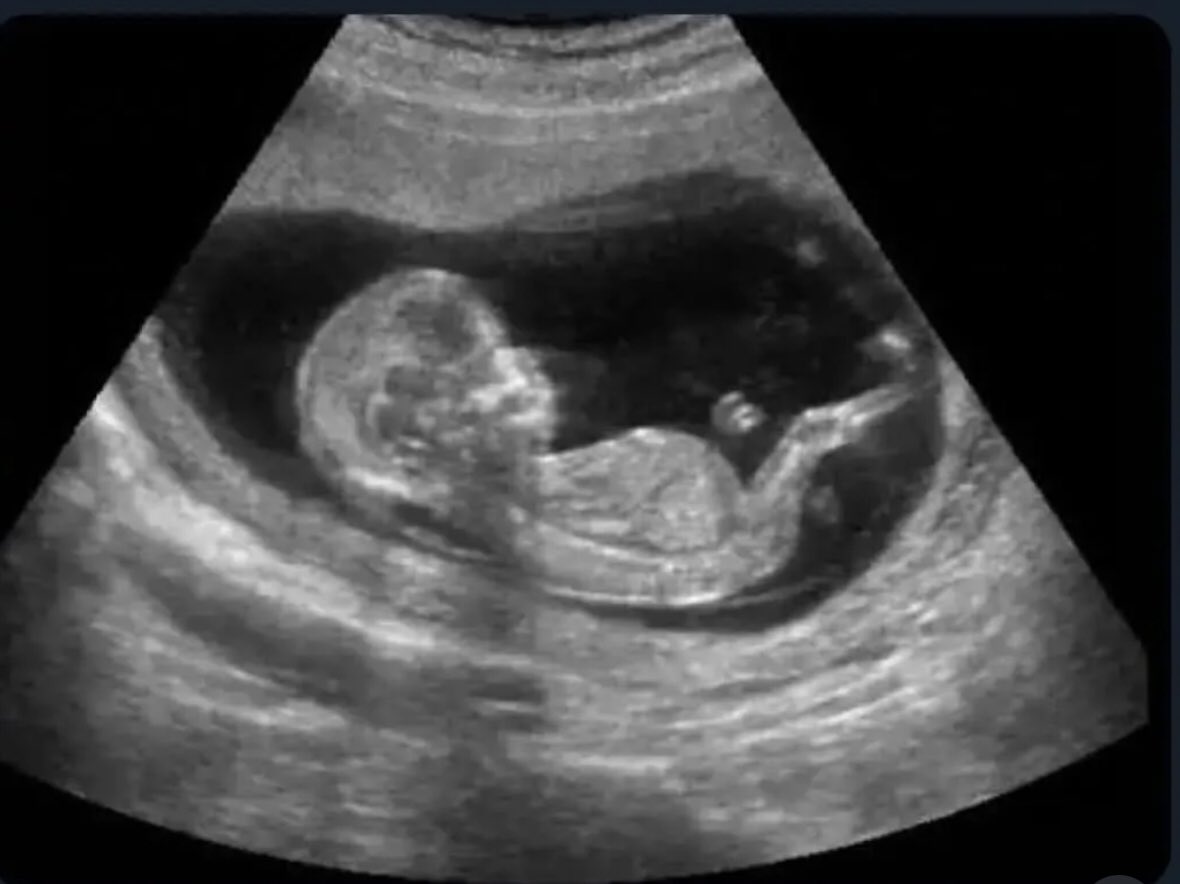 A pic of me the last time I was happy, mentally stabled, and not tired!