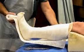 DGArmstrong's tweet photo. The Back Slab Steps Forward: When ‘Good Enough’ Beats the Gold Standard — Results of an RCT on TCC vs. Posterior Splint #ActAgainstAmputation #Offloading #DiabeticFoot https://t.co/LHolJiiqUQ https://t.co/VKekZwHio7