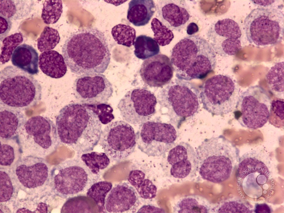 sanamloghavi's tweet image. APL variant morphology! 🧐 Less prominent granules &amp;amp; a bilobed/folded nucleus can be key for diagnosis. Don't miss subtle clues: FISH for PML::RARA (Peter Maslak; Susan McKenzie;) / ASH Image Bank #MedEd #Hematology #ASHImageBank #hemepath 🩸🔬 imagebank.hematology.org/image/1873 
@KMirza