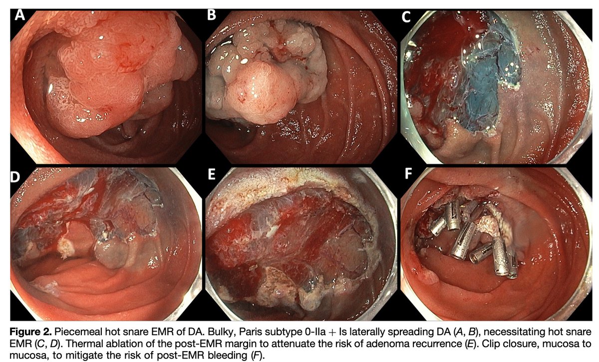 AchintyaSinghMD's tweet photo. AGA practice update for non-ampullary duodenal lesions: https://t.co/gQKT0UFzvv

🍯>20mm/ Is: Hot snare 
🍯<20mm: Cold snare 
🍯Review their colonoscopy records, if not in last 3 yrs, repeat 
🍯>30 mm polyps 25% bleeding risk, risk benefit less clear than colon polypectomy https://t.co/OJQl4ewD1m