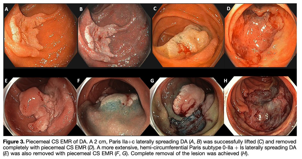 AchintyaSinghMD's tweet photo. AGA practice update for non-ampullary duodenal lesions: https://t.co/gQKT0UFzvv

🍯>20mm/ Is: Hot snare 
🍯<20mm: Cold snare 
🍯Review their colonoscopy records, if not in last 3 yrs, repeat 
🍯>30 mm polyps 25% bleeding risk, risk benefit less clear than colon polypectomy https://t.co/OJQl4ewD1m