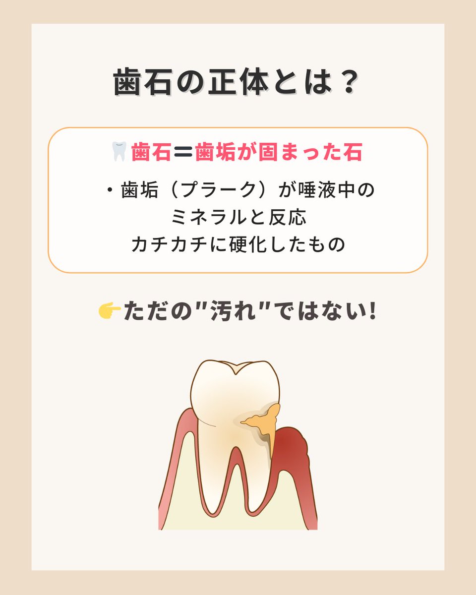 YCwhitening's tweet photo. 歯石はただの汚れではなく
“トラブルの巣“になるもの。

歯石が付くと表面がザラつく→細菌が付きやすくなる🦠→歯ぐきの炎症や出血に🩸

毎日磨いていても防ぎきれないからこそ、定期的な除去が必要です。

放置せず、きちんとクリーニングでリセットを。 https://t.co/BIZPAeV9XU