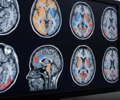 Gül esansiyel yağının düzenli olarak solunması insan beynindeki gri madde hacminde ölçülebilir artışlara yol açabileceği gösterildi.  
Her gün kıyafetlerine esansiyel gül yağı uygulayan 28 ve sadece su uygulayan 22 kadın, beyin MR' ları ile değerlendirildi.
Gül yağı kullananlarda