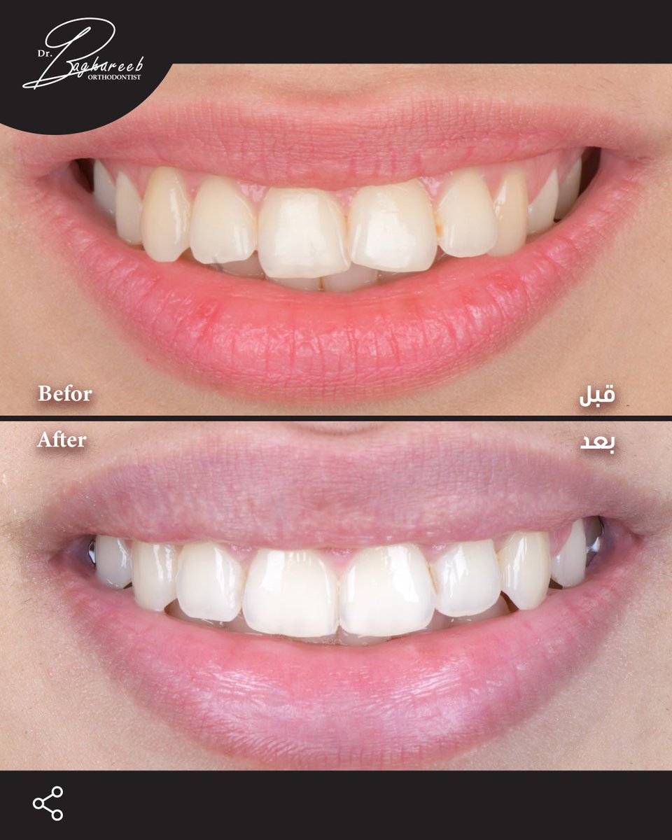 dr_baghareeb's tweet photo. One of the most rewarding parts of my work is seeing how Invisalign can transform a smile gradually and naturally.
With the right diagnosis and treatment plan, we can improve alignment, bite, and overall smile harmony 🤍🙏🏻

#invisaling #dental #ortho https://t.co/ldM5Z6RG9z