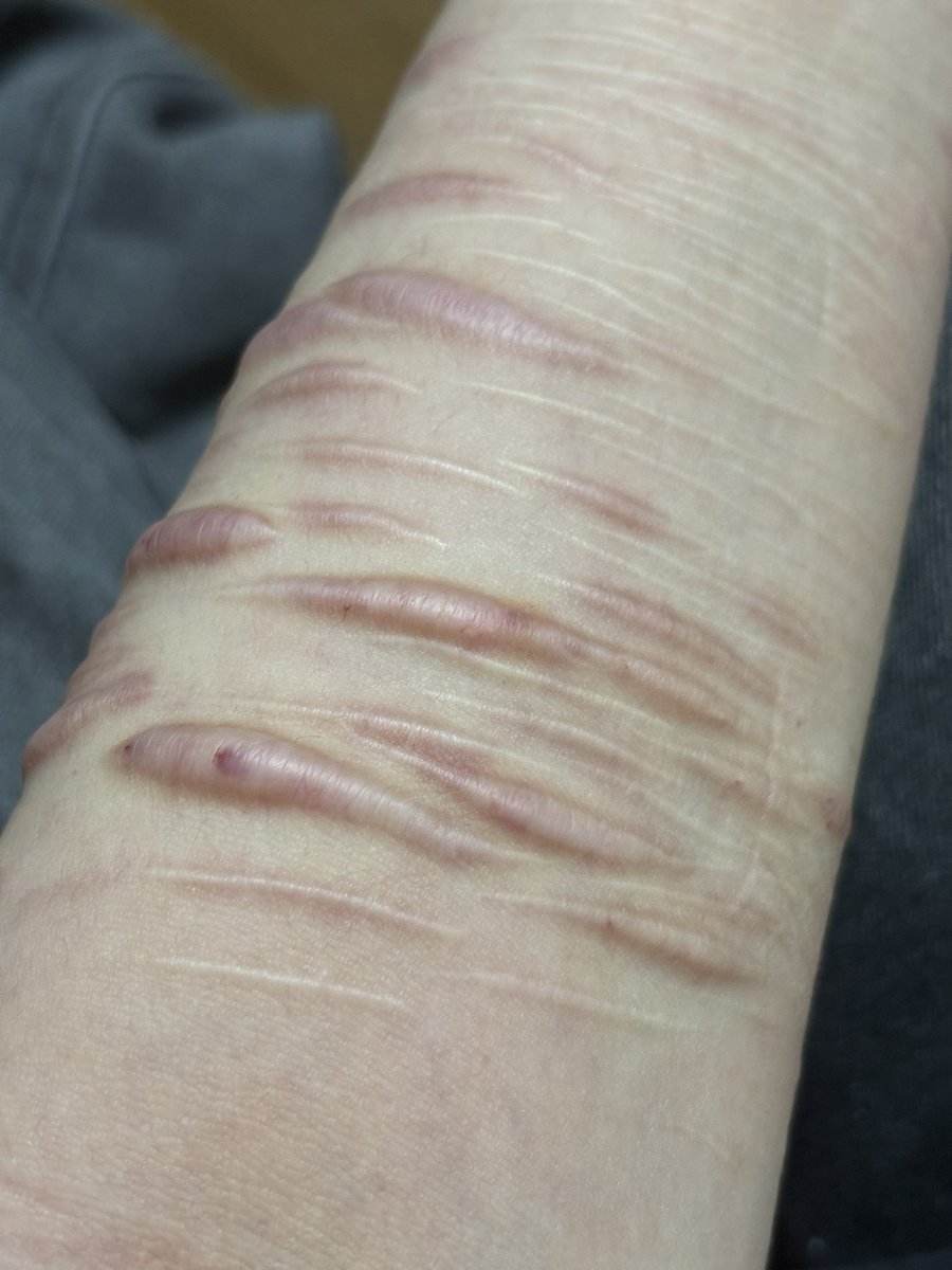 ry27841's tweet photo. リスカ跡のステロイド注射💉レポ
・1つのケロイドに1回注射、みたいな感じで沢山ぷつぷつ刺された
・2、3週間感覚を空けて2、3回打つ必要がある
・正直もう行きたくないくらい痛すぎた。泣いた。切ったときの方が痛くない
・私が行った皮膚科では保険を適用させてくれて無料だった https://t.co/5ow5Mwrxt2