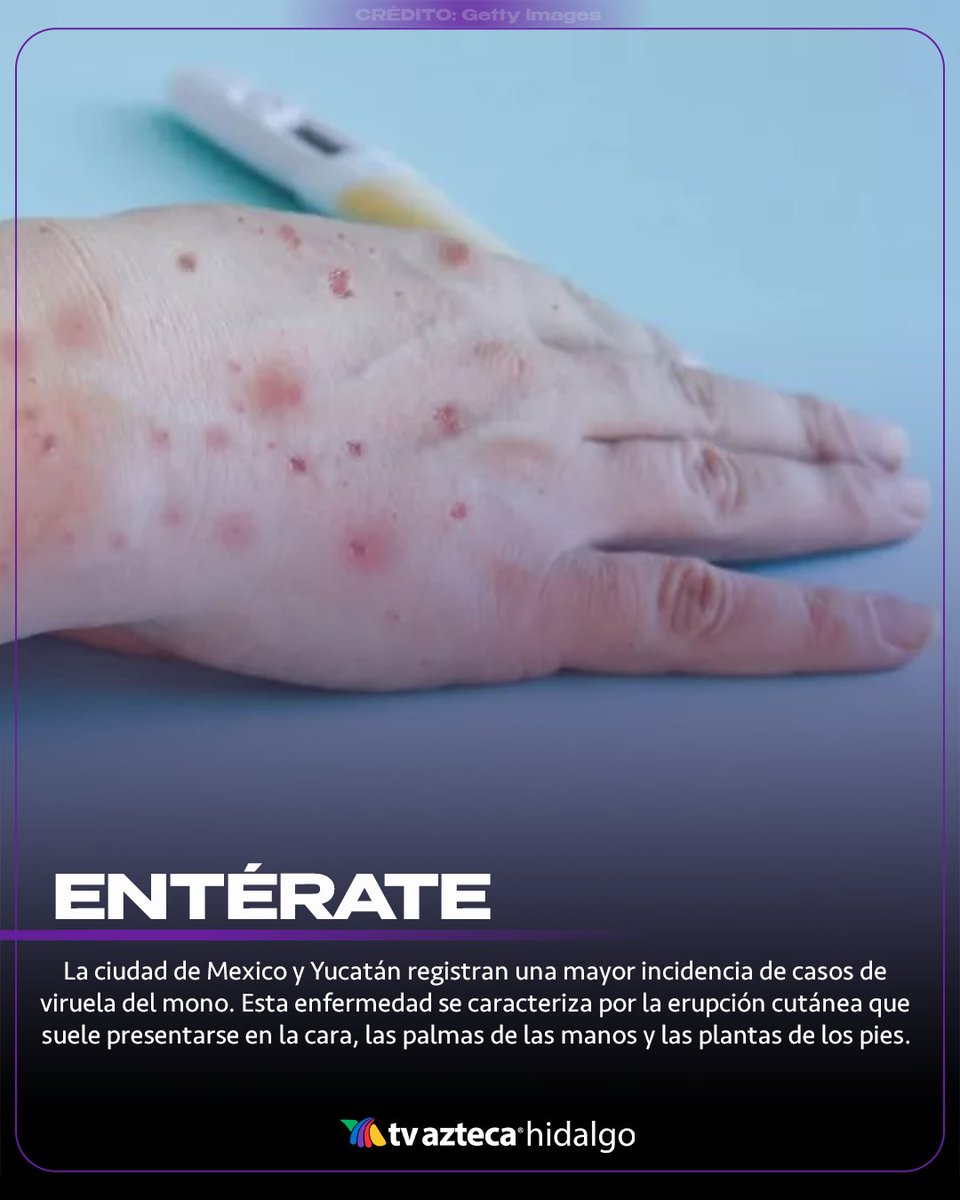 #Entérate | 🦠🔬 La viruela del mono se contagia por contacto directo o indirecto con sangre, fluidos corporales, las lesiones de la piel o las mucosas de animales infectados. Los síntomas son similares a los de una gripe y se prolongan durante 2 a 4 semanas. 🤒🩺