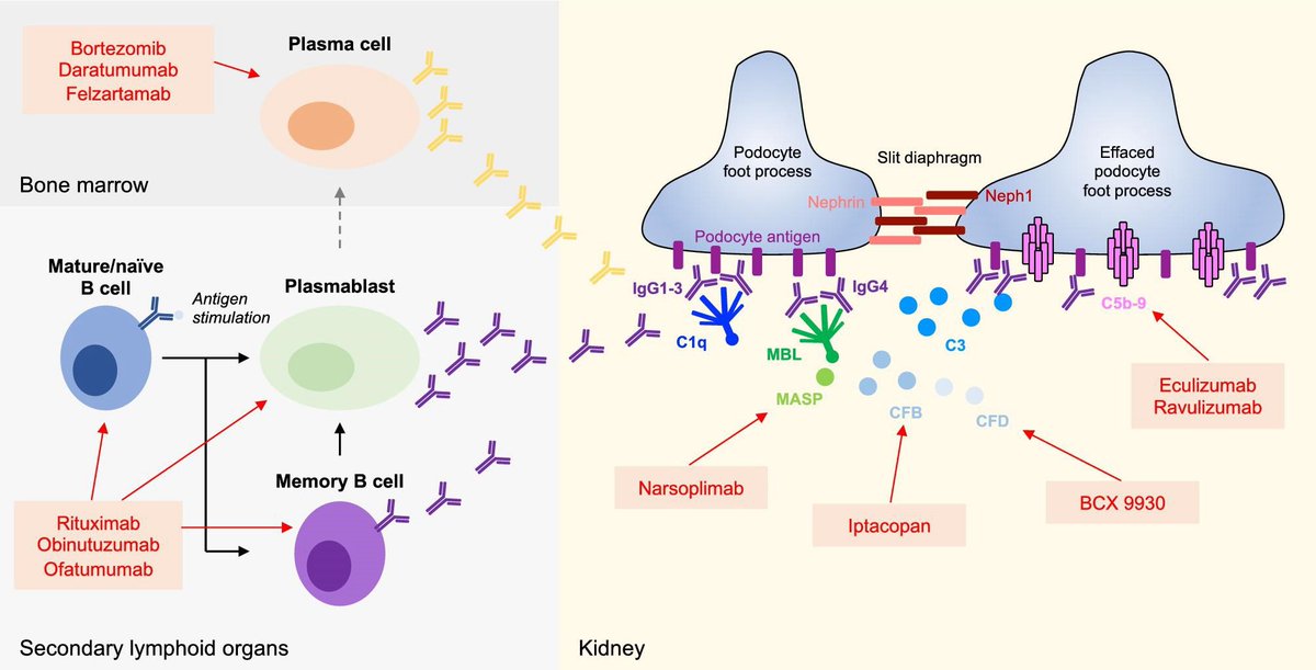 hardik4u24's tweet image. 🧬Membranous nephropathy= autoantibodies→ complement→ podocyte injury

🟣B cells &amp;amp; plasma cells make antibodies
🧪Classical/lectin pathways→ C5b-9
🫘Foot process effacement→ proteinuria

🎯 B cells, plasma cells, complement

🔗 doi.org/10.1093/ckj/sf…

#Nephrology #MN