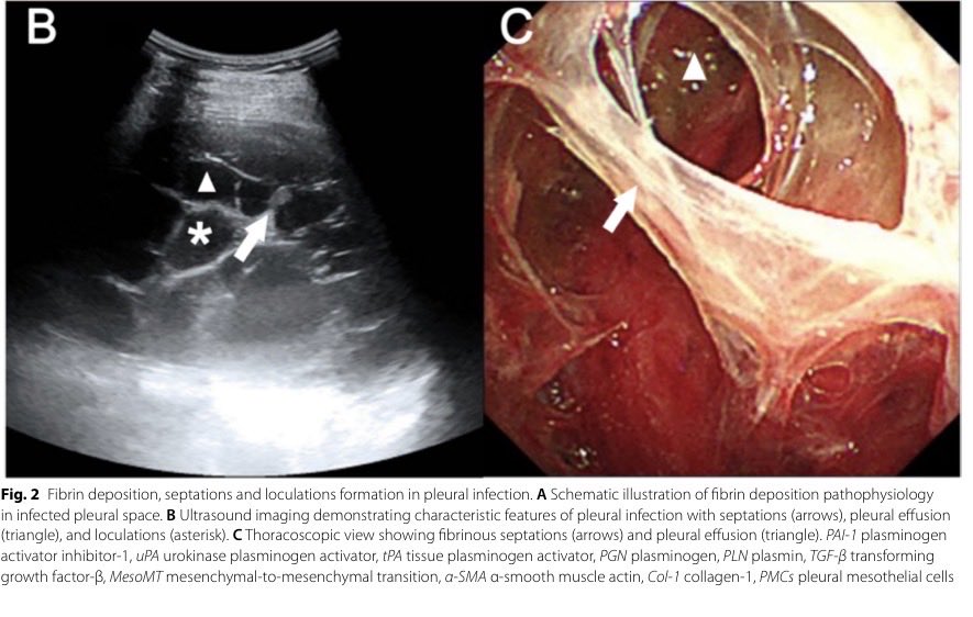 Las #neumonias🫁pueden complicarse: #DerramePleuralComplicado o #Empiema🟢y los #AntibioticosSistemicos NO son suficientes💊❌.En #EurJMedRes REVISIÓN🙇🏻‍♂️ sobre CUANDO⏳y COMO 🔪💉utilizar tratamientos #locales (drenaje, suero, ATB, cirugía…)
🔗🆓 link.springer.com/article/10.118…