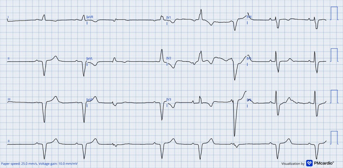 A 72 yo male presents to the ED with worsening functional status (NYHA IV) &amp; anasarca.

• TTE: LVEF 23%, 4-chamber dilation, severe AR, MR and TR.
• CCT: no significant obstructive CAD, but TIMI 2 flow in all coronary vessels.

What do you think is the underlying etiology?