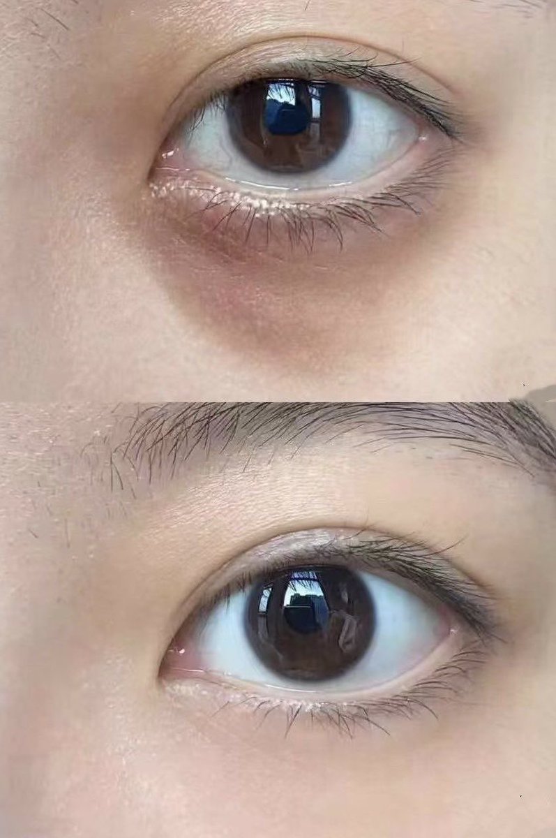 theothermimi_'s tweet photo. Patutlah ramai borong eye cream Kumargic ni kat jepun, hilang siot dark circle bawah mata. Sekali dengan kedut2 tu lesap sekali 😭😭 https://t.co/0W1tWKuOb6