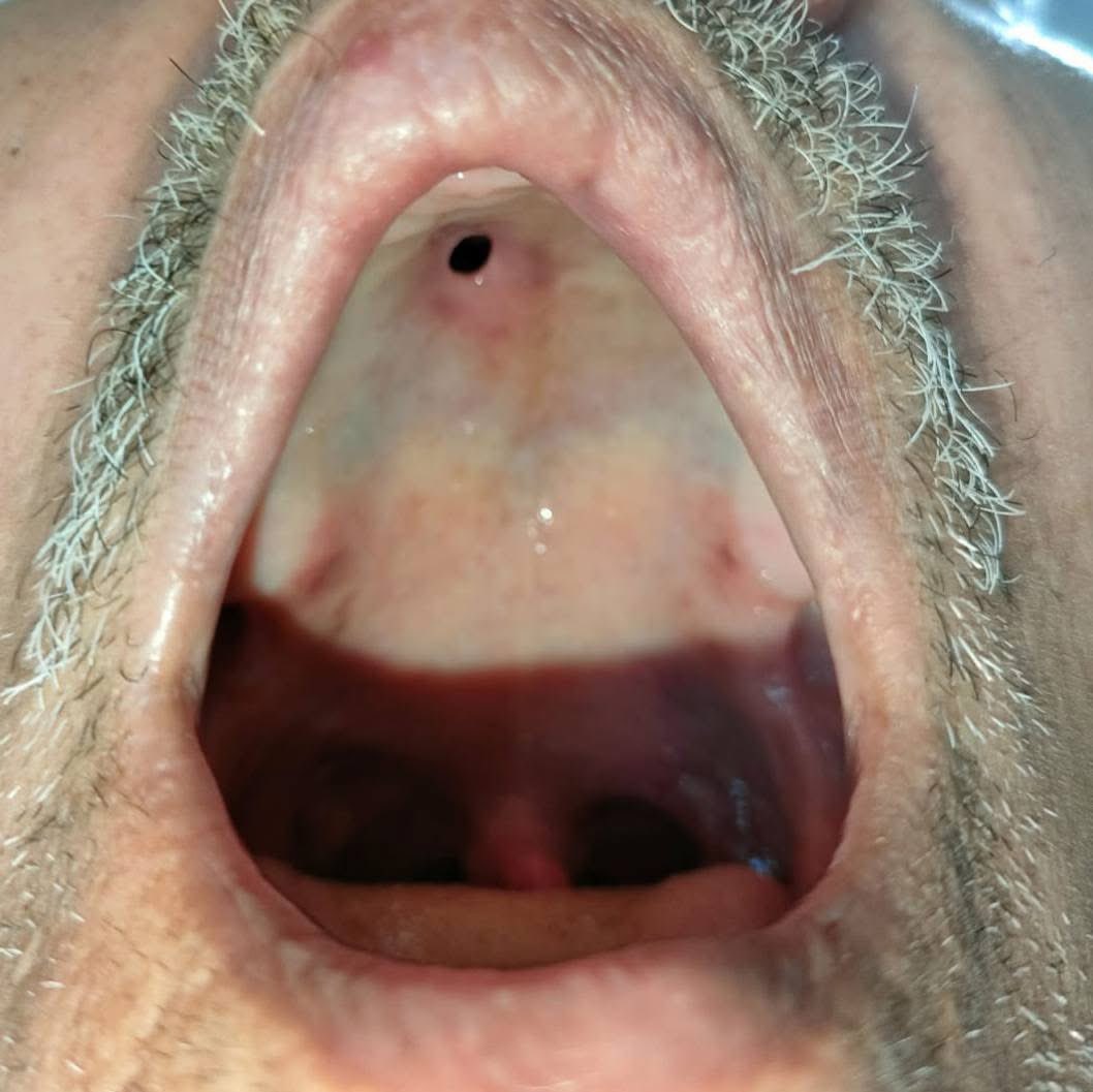 hemo_shk's tweet photo. #Interesting_case
A 50-year-old male presented with nasal regurgitation of food and fluids.
What’s your opinion?!
#MedX #MEDHM @IhabFathiSulima https://t.co/w2FjdWn1Df
