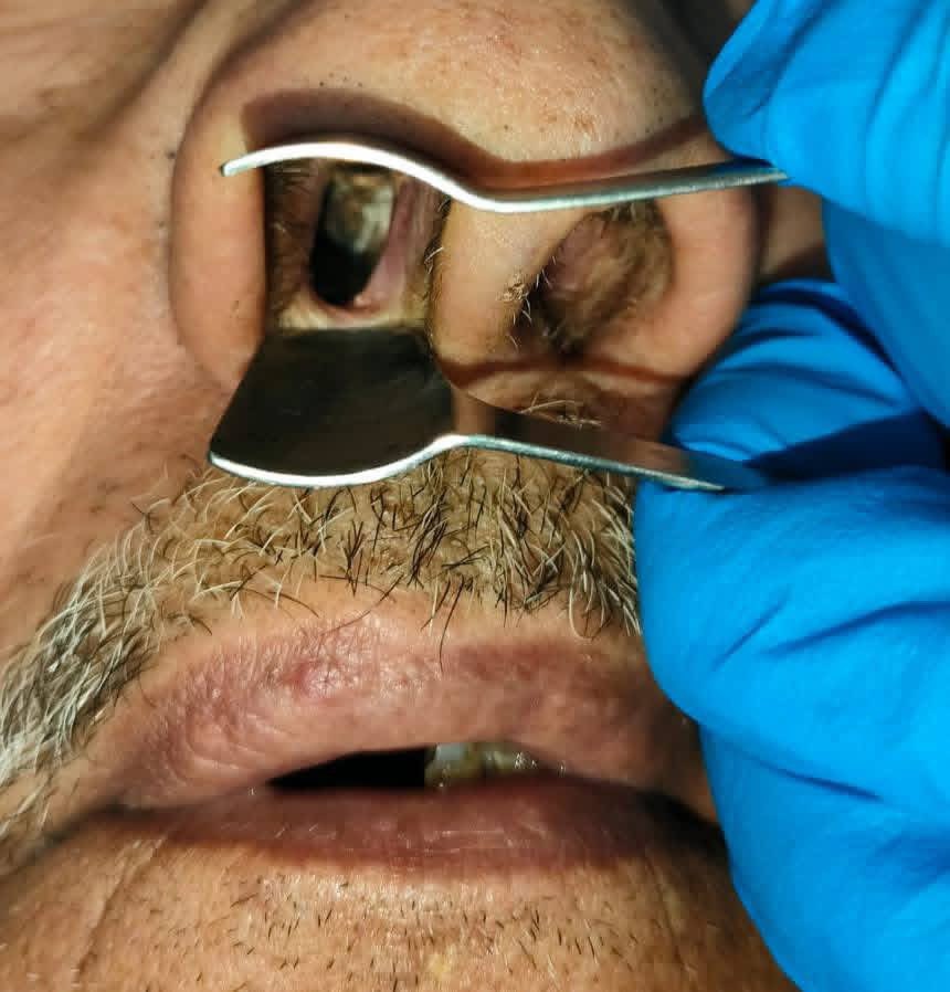 hemo_shk's tweet photo. #Interesting_case
A 50-year-old male presented with nasal regurgitation of food and fluids.
What’s your opinion?!
#MedX #MEDHM @IhabFathiSulima https://t.co/w2FjdWn1Df