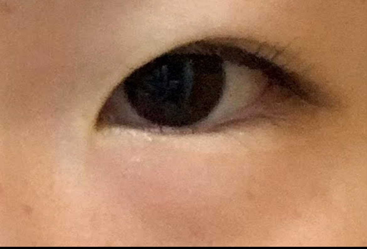 choco25late25's tweet photo. 目頭切開前
今
3年前

完全に後戻りしてるよなあ笑 https://t.co/oq0Xp5qu3W
