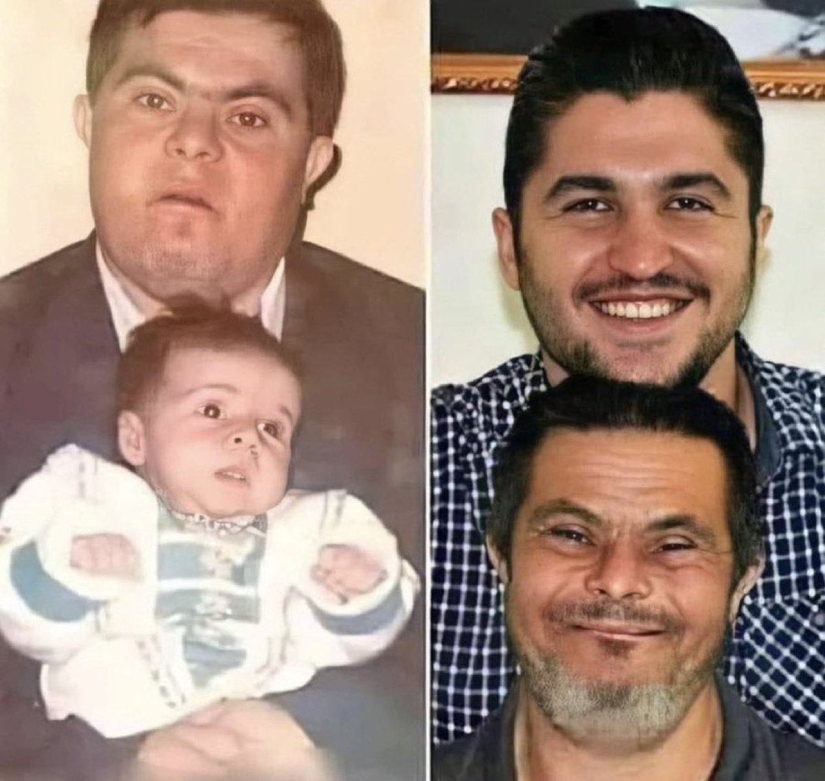 ▪️Down sendromlu bir baba, tüm zorluklara rağmen oğlunu büyüttü ve bugün oğlu bir doktor oldu.