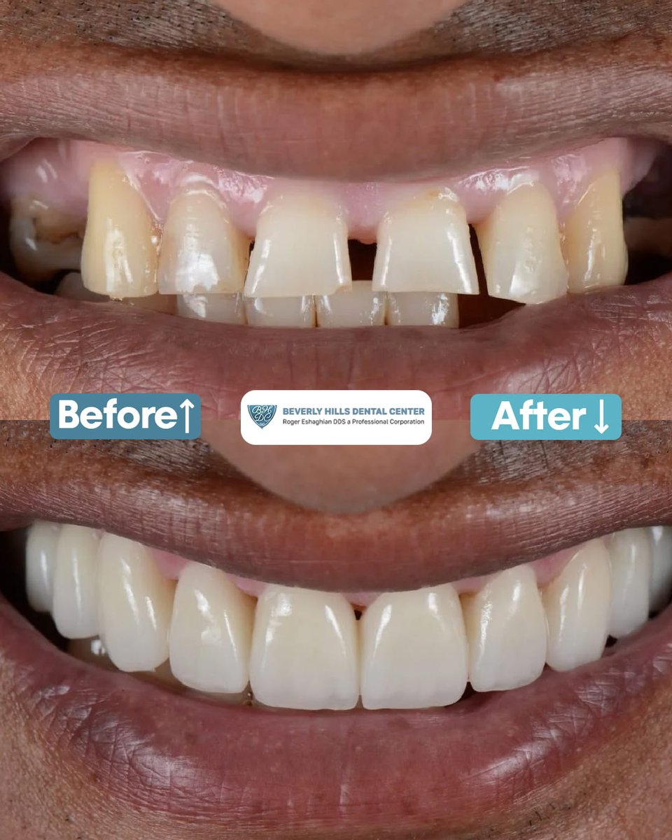 BHDentalCenters's tweet image. A gap closed, a confidence gained.

This transformation showcases the power of a tailored smile makeover. Dr. Eshaghian takes pride in listening to his patients and delivering results that are both beautiful and functional.

#beverlyhillsdentalcenter #smilemakeover #teethgap