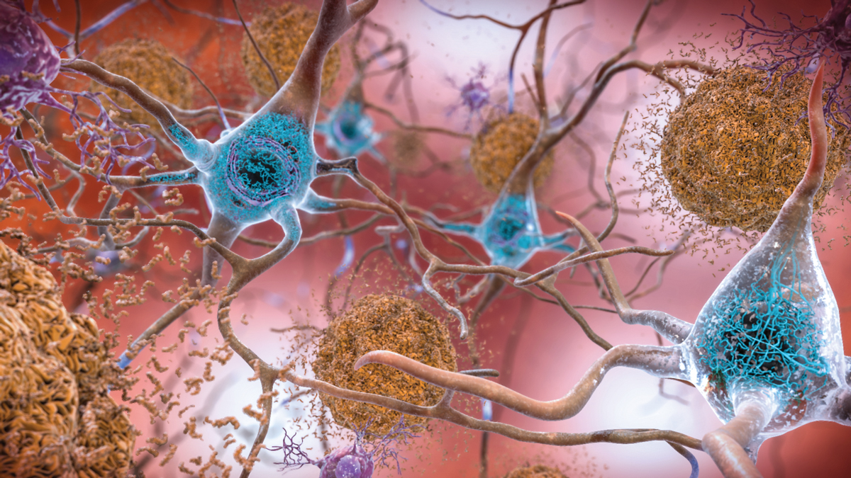 mac_anas's tweet image. Inflamación sistémica, delirio y progresión clínica en la enfermedad de Alzheimer leve-moderada

 | eBioMedicine

fundacionfemeba.org.ar/blog/farmacolo…