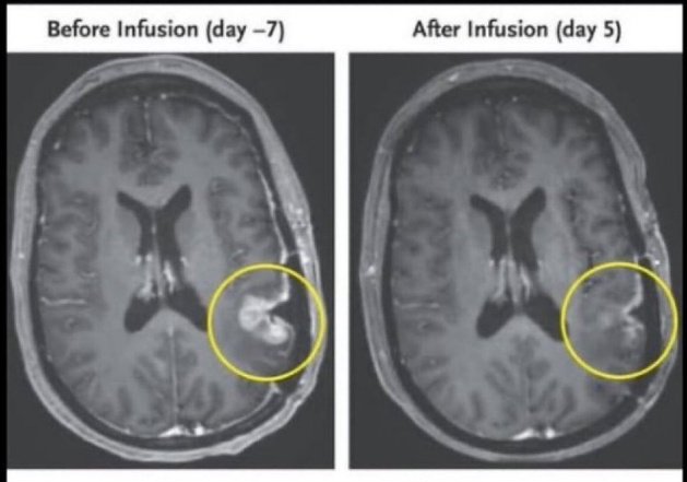 DEMOCRACIAPONTO's tweet photo. 🚨 CURA DO CÂNCER CEREBRAL 
VIVA A CIÊNCIA DO BRASIL

A ciência do Brasil surpreende o mundo

Uma única dose de um novo medicamento contra o câncer fez um tumor cerebral quase desaparecer em apenas 5 dias.
No início de 2024, médicos do Hospital Geral de Massachusetts trataram três pessoas com glioblastoma recorrente usando um novo tipo de terapia com células CAR-T chamada CARv3-TEAM-E. 
O tratamento é feito com as próprias células imunológicas de cada paciente, que são coletadas, geneticamente reprogramadas em laboratório para reconhecer dois marcadores diferentes comumente encontrados em células de glioblastoma e, em seguida, infundidas diretamente nos espaços fluidos do cérebro por meio de um único procedimento. 
Um 2⁰ paciente teve mais de 60% do tumor reduzido, e essa diminuição durou mais de seis meses. 
O 3⁰ também apresentou uma redução significativa do tumor em poucos dias.