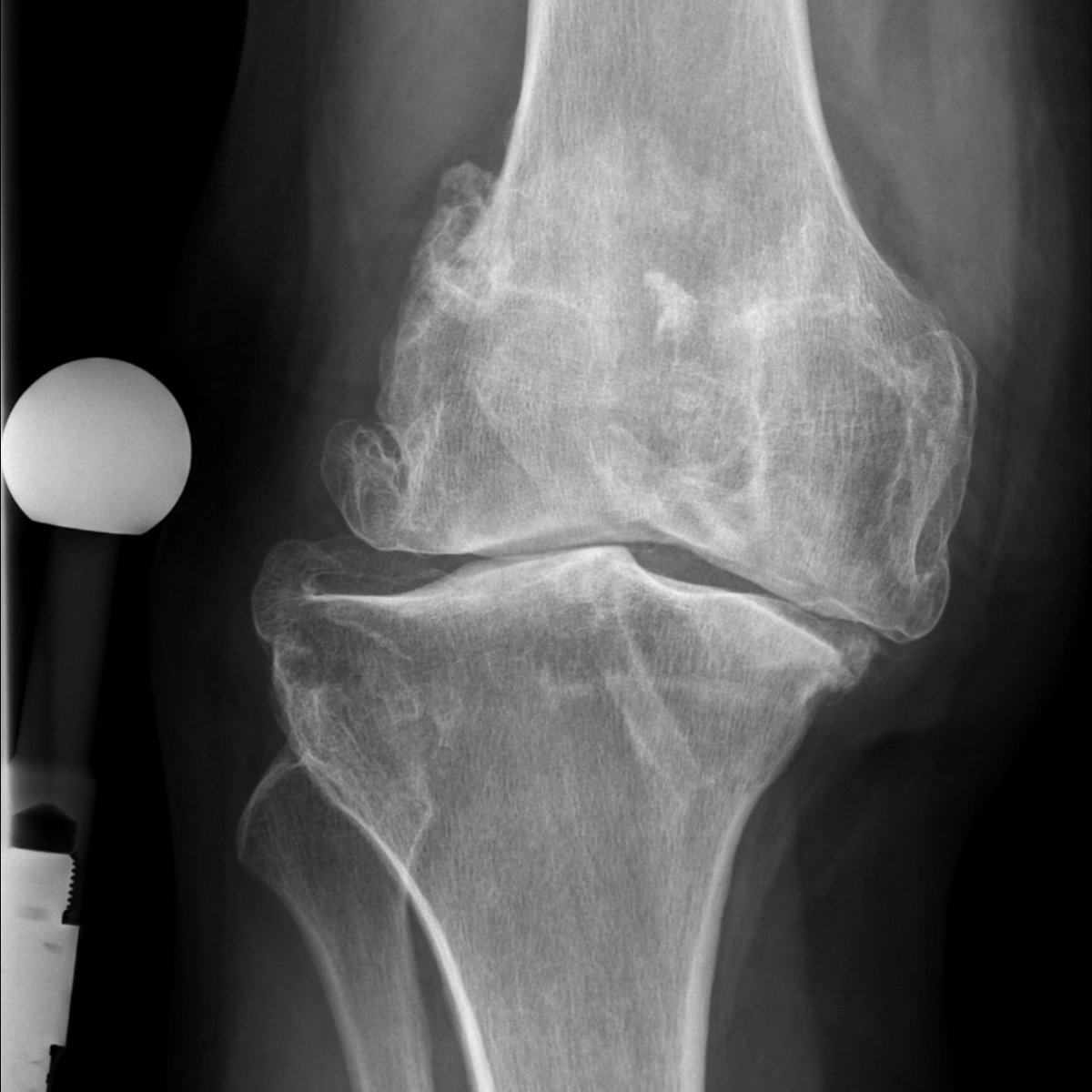 COVID19_disease's tweet photo. BREAKTHROUGH: 

Stanford University Scientists Discover Method to Regrow Aging Cartilage and Reverse Arthritis https://t.co/C48frEsvPU