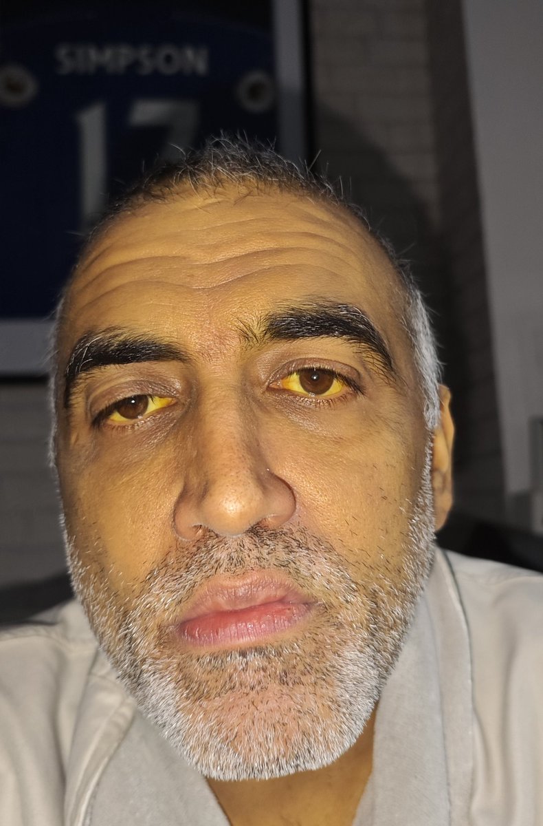 So after 35 days out of hospital, after 23 days in it, I'm now back in hospital. My bilirubin, which should be 20 is 380. It was between 155-180 my 1st time here. I'm even more yellow now! No idea what's going on it was a supplement induced liver injury but 66 days in and this ..