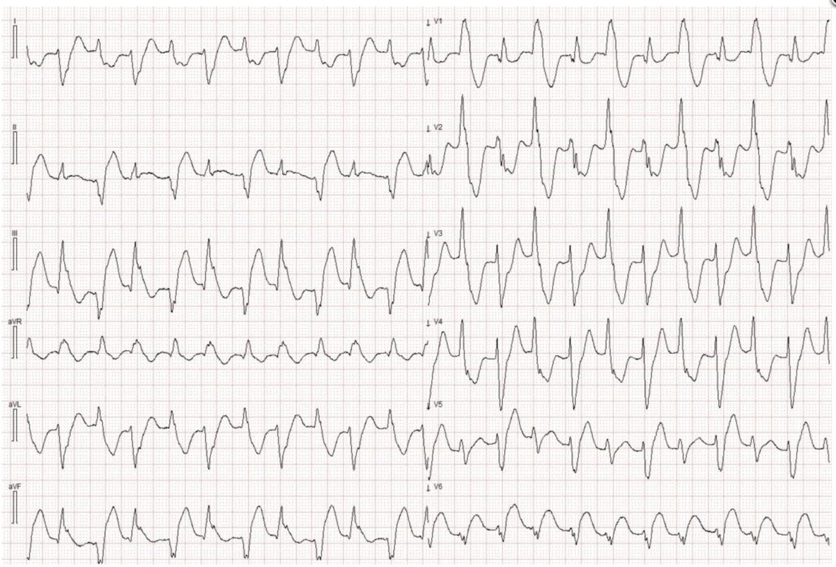 Fascinating Wide Complex Tachycardia and instructive ECGs during chest pain

drsmithsecgblog.com/fascinating-wi…

<a href="/MagnusNossen/">Magnus Nossen, MD</a>