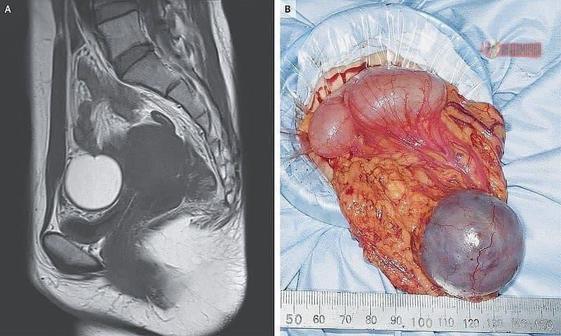 IhabFathiSulima's tweet image. A 37-year-old woman complained of #cramps and #pain in her lower abdomen during her #period.  A laparoscopy was performed and a diagnosis of ?
A. Peritoneal carcinomatosis.
B. Pancreatic cancer.
C. Omental Endometriosis.
D. Ovarian teratoma.