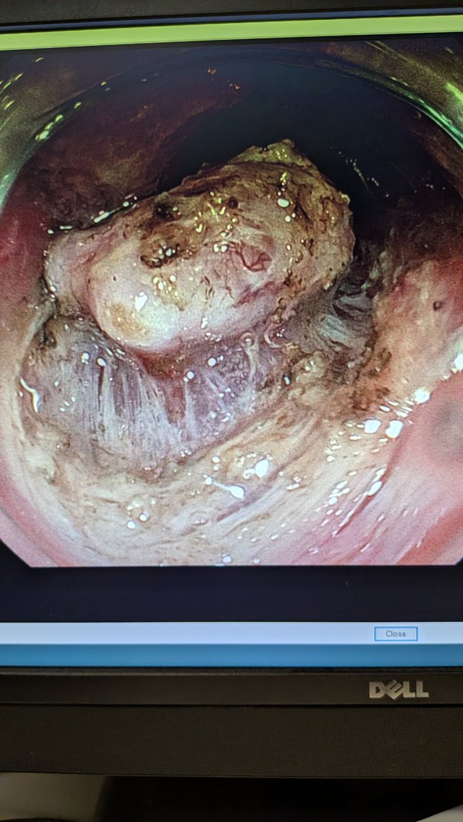 Prashant Kedia MD, FACG, FASGE tweet media