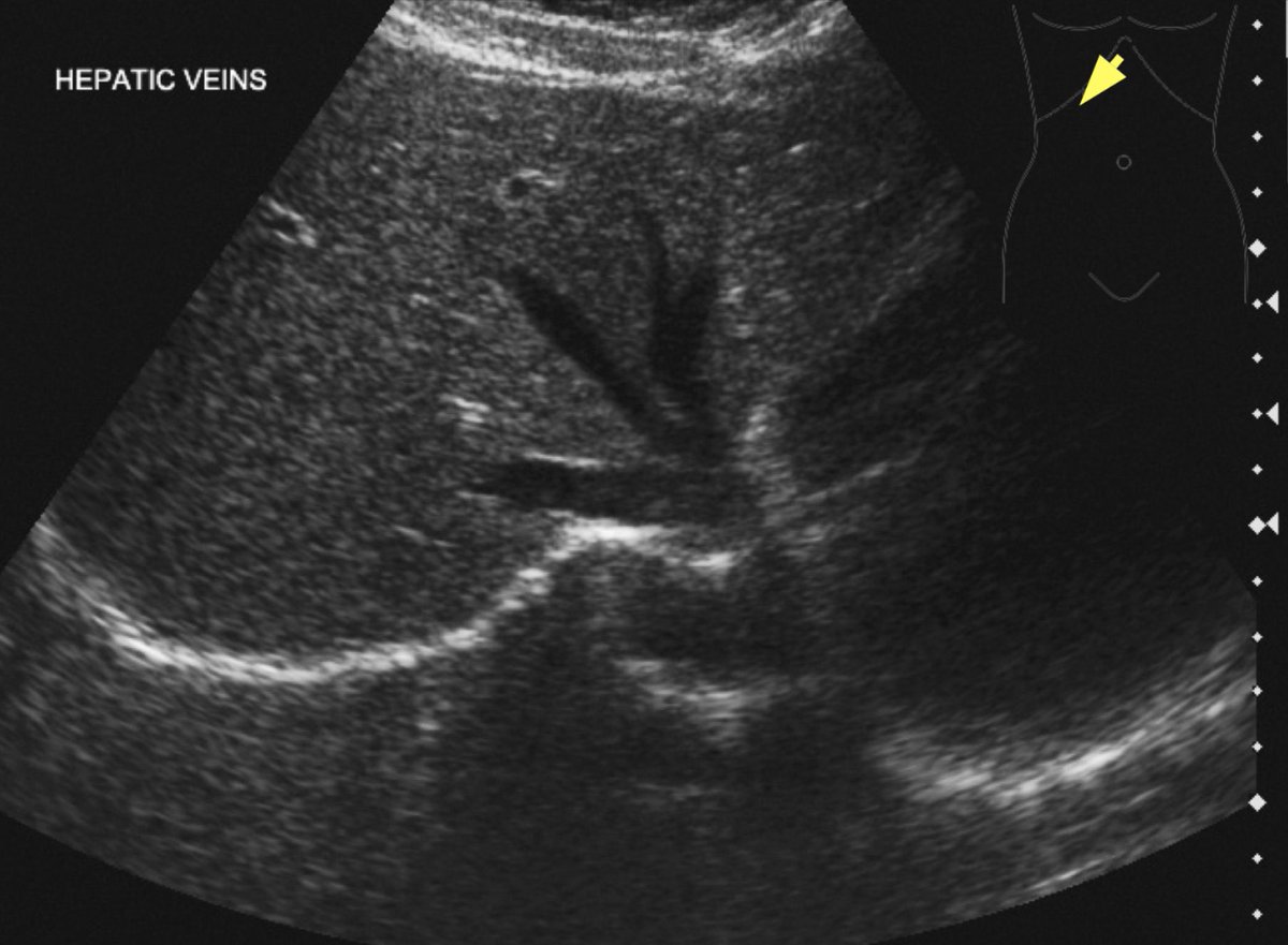 POCUSpeek's tweet photo. Deep breath in &amp; at the same time angle the probe cranially under the costal margin 👇 [from 📕Practical ultrasound, an illustrated guide - Jane Alty &amp; Edward Hoey] 🤩 #POCUS #ultrasound #fusic #famus #FOAMEd https://t.co/W7Pg5rqJAo