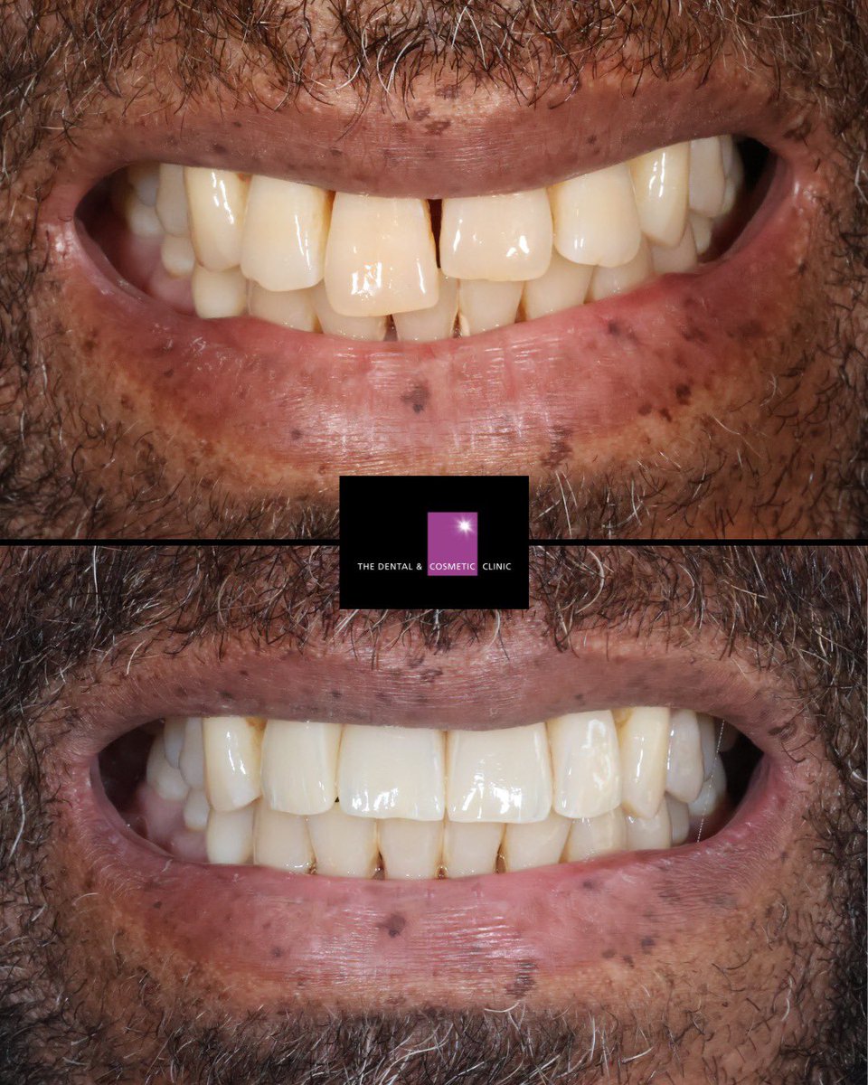 A loose and over-erupting front tooth associated with severe gum disease had left this patient feeling self-conscious. With a <a href="/swedenmartina/">Roberto SWEDEN & MARTINA</a> Prama implant bridge, we restored his smile, confidence, and trust in dental care! 
#beuniquebeprama #dentalimplants #smilemakeover