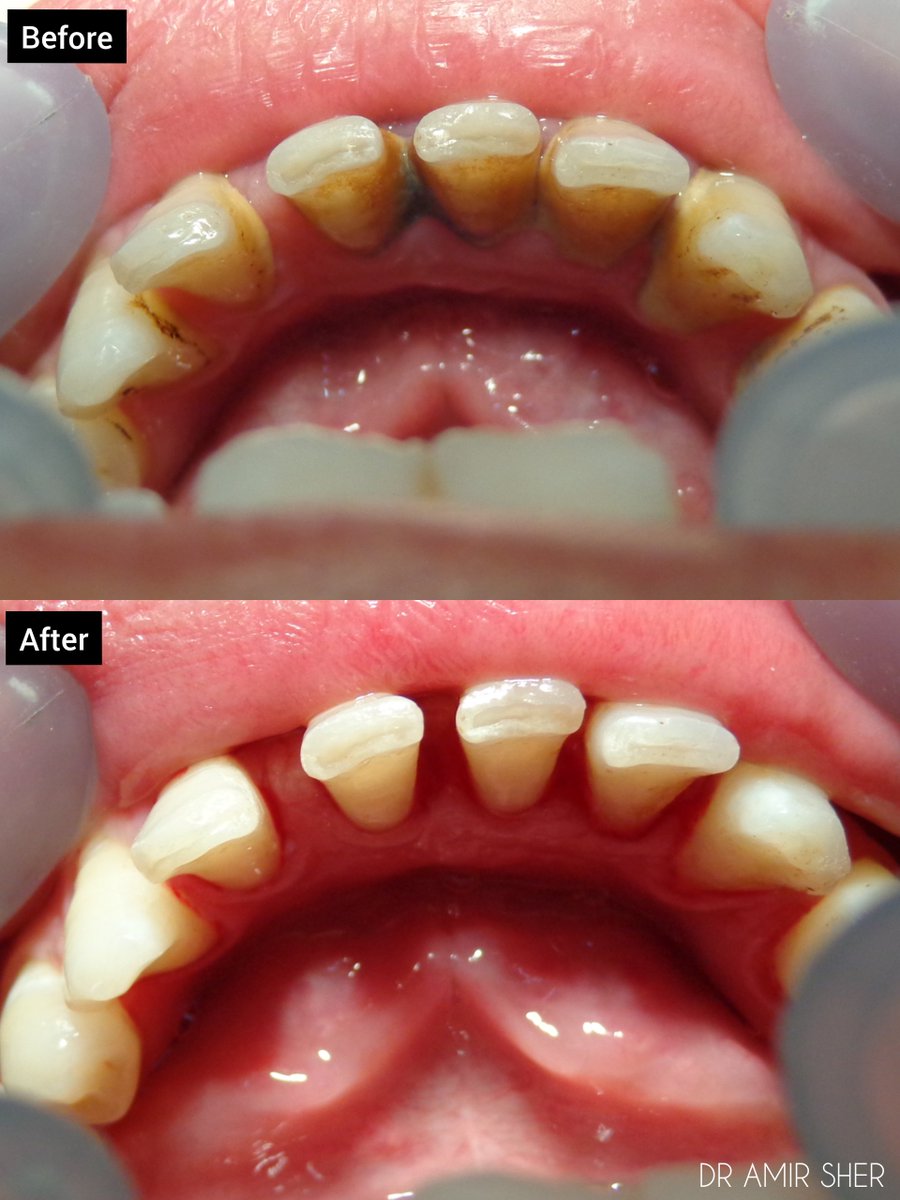 Primedental7's tweet image. Comprehensive scaling for plaque control, reduced inflammation, and periodontal stability 🦷✨

#Scaling
#PlaqueControl
#Oralhygeine
#Periodontics
#Dentistry