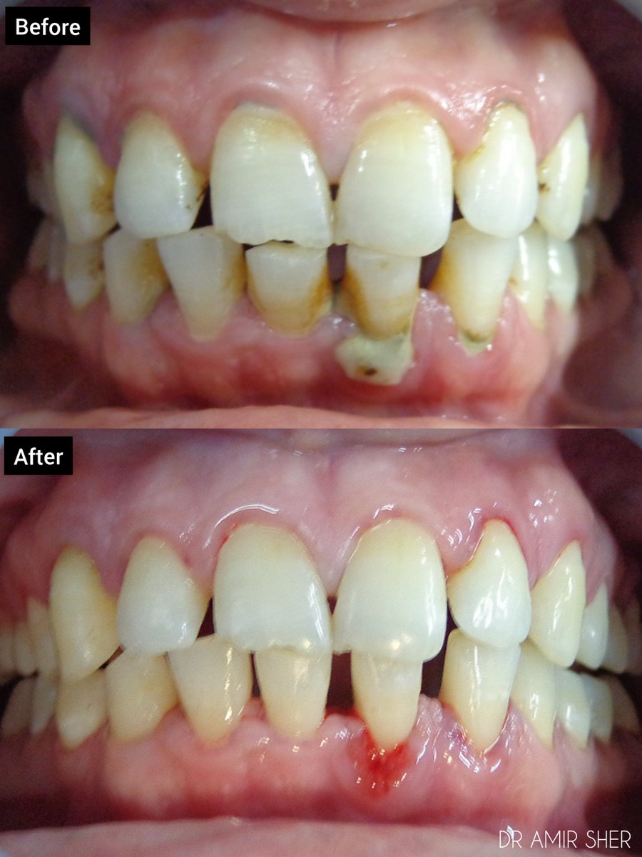 Primedental7's tweet image. Comprehensive scaling for plaque control, reduced inflammation, and periodontal stability 🦷✨

#Scaling
#PlaqueControl
#Oralhygeine
#Periodontics
#Dentistry