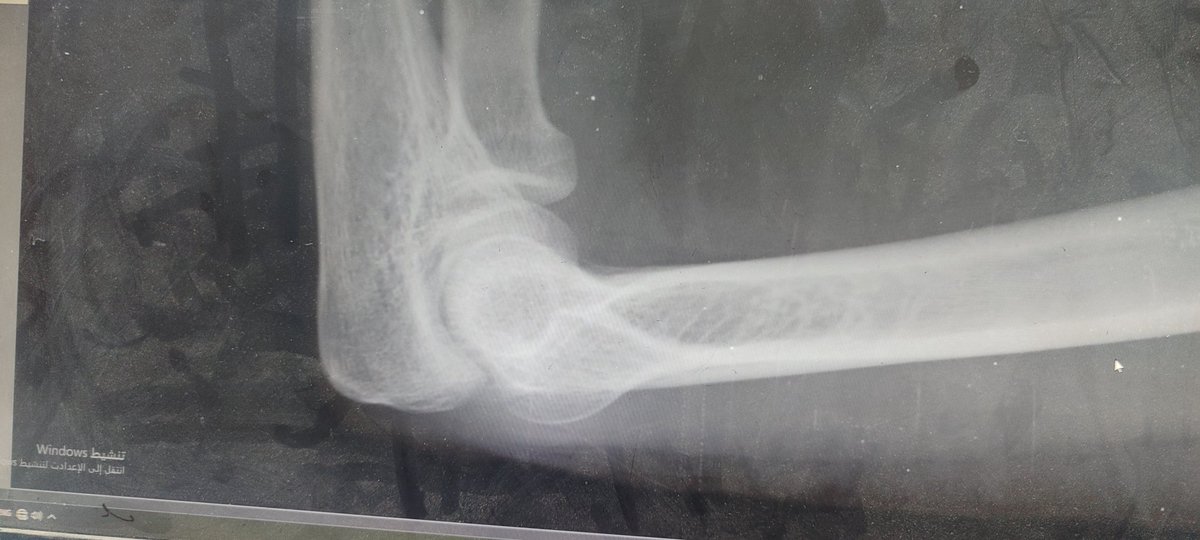 Today is very difficult because I am in pain. 

I fell down the stairs. I went to the hospital, and they took an x-ray of my hand. It turned out I had a fracture in my elbow and wrist joint. My hand swelled up, and now I'm in a lot of pain—unbearable pain. 

This is the x-ray