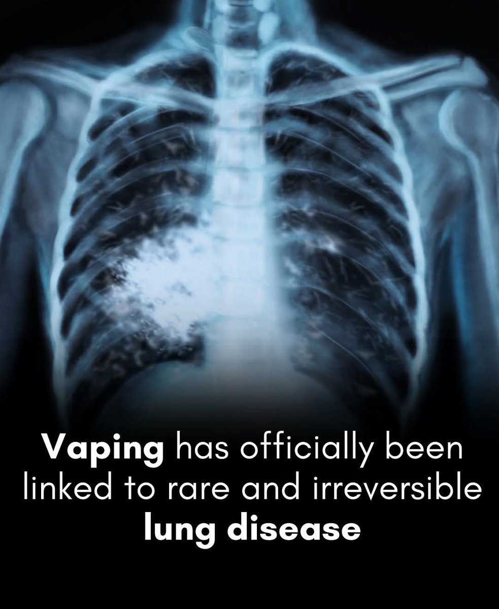 ShiningScience's tweet image. 🚨This lung damage from e-cigarettes is permanent — and entirely preventable.

Flavored e-cigarettes, often marketed with candy-like appeal, may be far more dangerous than they seem. 

A recent case involving a U.S. teenager who developed bronchiolitis obliterans—commonly known