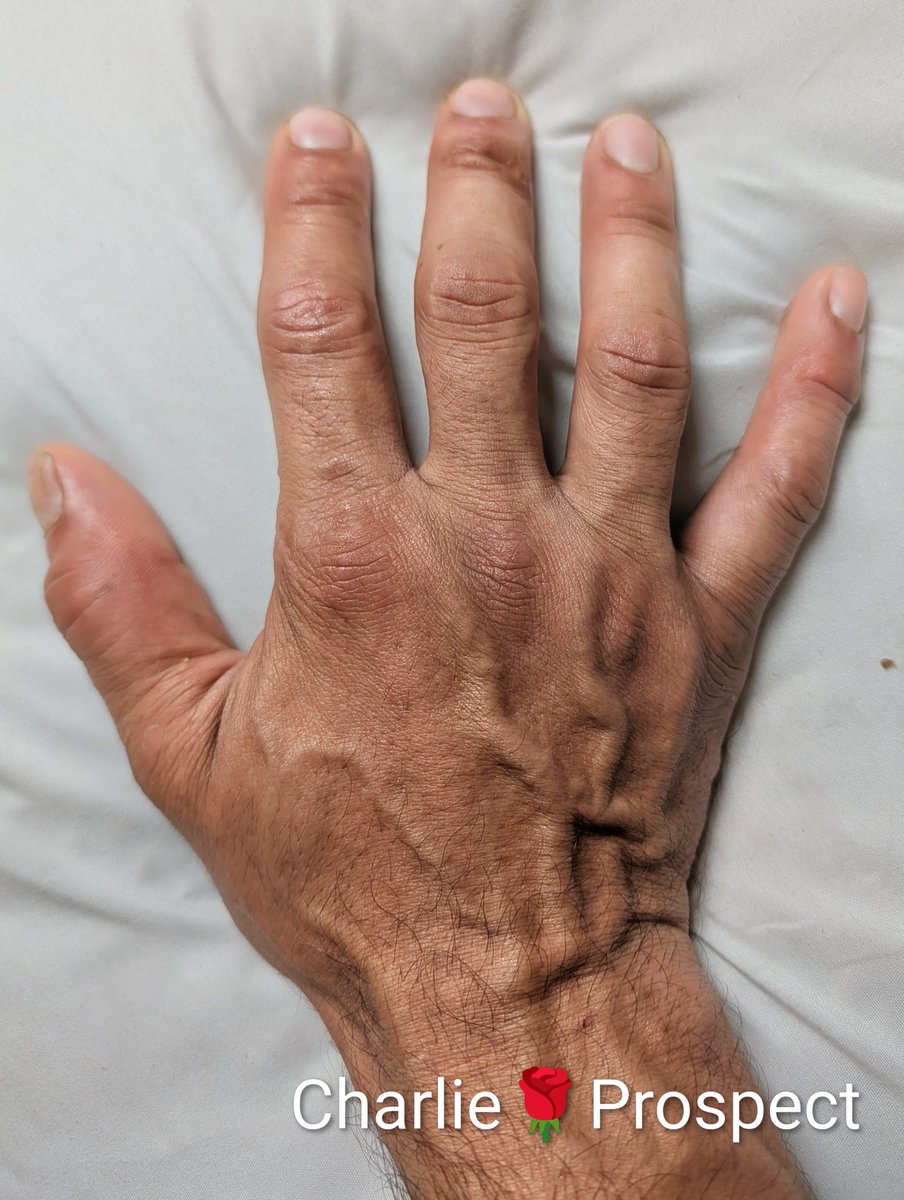 The Charlie🌹Prospect Erotic Bodywork Blog does it again- in your pants! Hands- THE DEVILS WORKSHOP! I see your hairy palms, mine are hairy as hell.
Your palms are live wires to your nervous system, and when I work them, I wake up sensation, restore mobility, and remind those