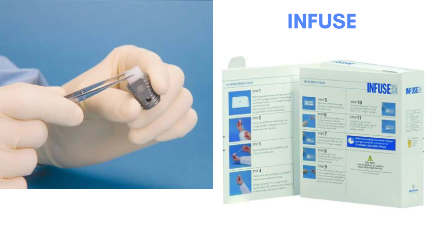 ODTmagazine's tweet photo. .@Medtronic's Infuse bone graft approved for 1- and 2-level TLIF procedures: https://t.co/Q4r6c2wli1
#spinalfusion #spinesurgery https://t.co/lydoycJBDP