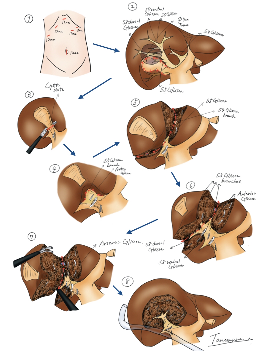jses_eng's tweet photo. JSES IllustCon 91
📌Hepatectomy using Gate-first approach, taking advantage of the laparocopic view
📝I present a laparoscopic partial hepatectomy of S4/5 using the Gate-first approach. In cases with the tumor adjacent to the anterior Glisson, dissecting the root of Glissonian pedicle before parenchymal transection can promise negative tumor margin.
🖊Tanemura Akihiro
#JSESイラストコンテスト　#JSES_illustration_contest