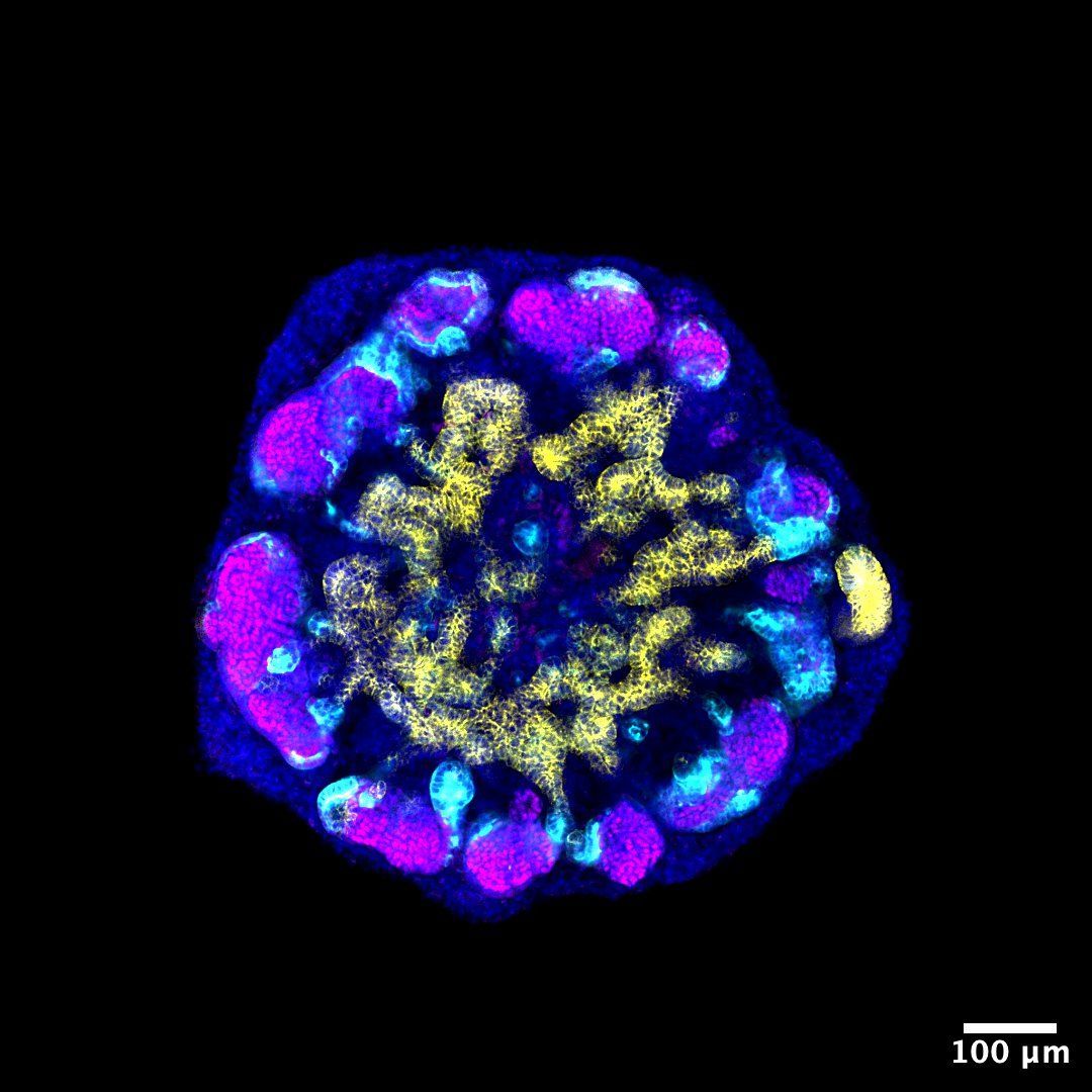 JCI_insight's tweet image. Alport syndrome is a frequent cause of hereditary glomerulonephritis, and some pathogenic variants affect RNA splicing.

In this Research Article, Hassan Saei @HassanSaei Guillaume Dorval @gdorval12 &amp;amp; team @Inserm establish a preclinical #kidney organoid platform of #Alport