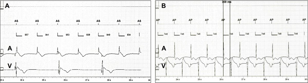 Heart Rhythm Case Reports tweet media