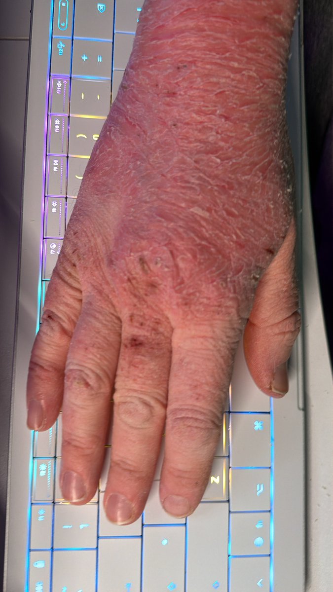 soren42's tweet photo. @DirtyEffinHippy Most of all, give yourself some time, and  some forgiveness. I came to all this after 45 years of being chronically ill.

You’ll get there. And your friends will be waiting.

(Here’s what my hands currently look like, to explain that whole skin remark in the first post…) https://t.co/3g2wgThTn2