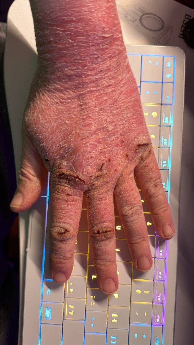 soren42's tweet photo. @DirtyEffinHippy Most of all, give yourself some time, and  some forgiveness. I came to all this after 45 years of being chronically ill.

You’ll get there. And your friends will be waiting.

(Here’s what my hands currently look like, to explain that whole skin remark in the first post…) https://t.co/3g2wgThTn2